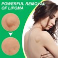 thumbnail image 4 of Crema De Eliminación De Lipoma Ungüento de celulitis de lipólisis ligero 20g de yeso antitumoral para moldear el cuerpo, 4 of 9