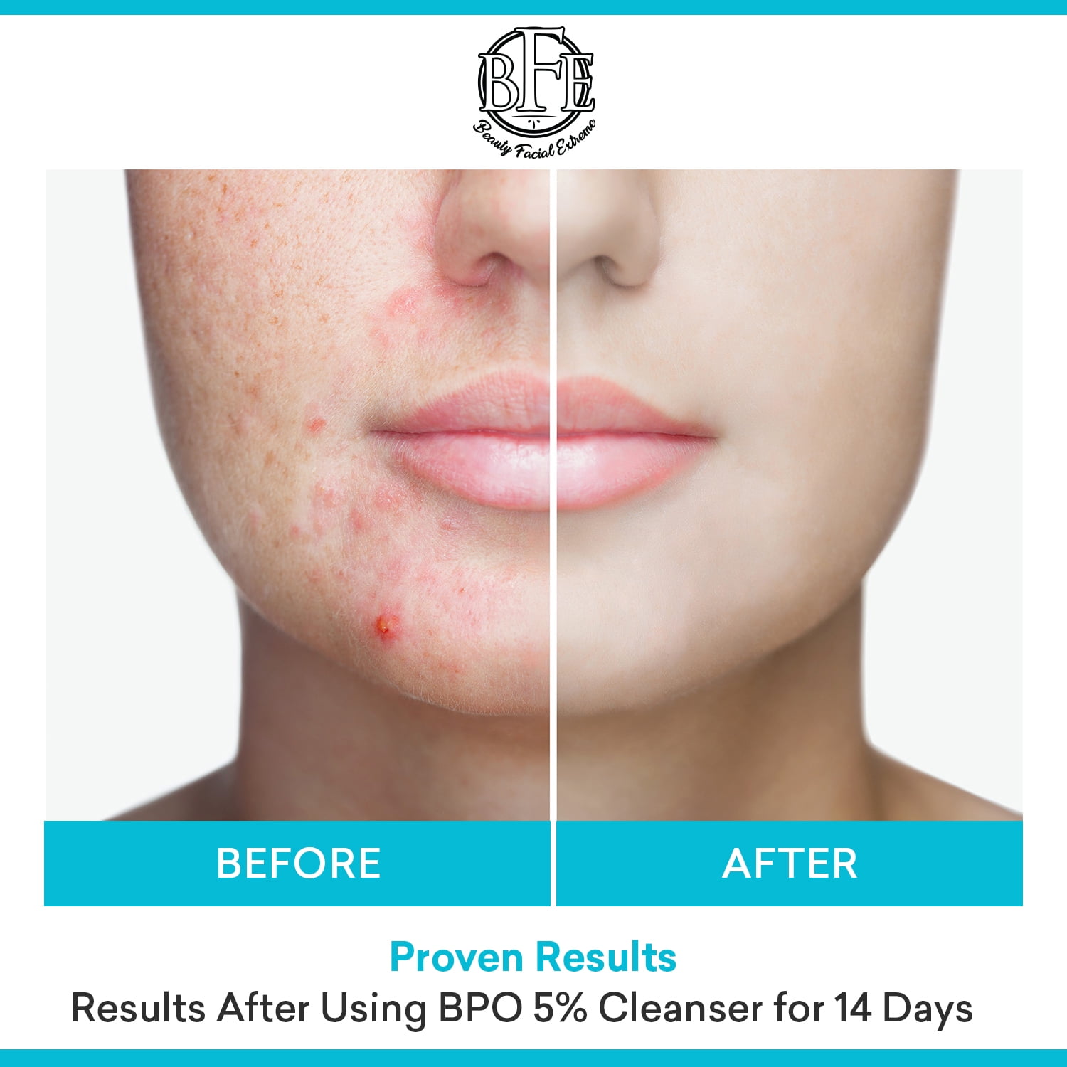 Acne Face Wash Treatment with Benzoyl Peroxide 5 Precent - Fight Acne Blemishes on Contact for Cystic Breakouts, Oily Skin, Clogged Pores, Blackhead, Whitehead & Pimples