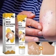 thumbnail image 2 of Vitiligo Bee-Venom Treatment Cream for Skin Pigmentation, Psoriasis Relief, Reduces White Spots, Portable Anti-itch Ointment for All Skin Types, 2 of 5