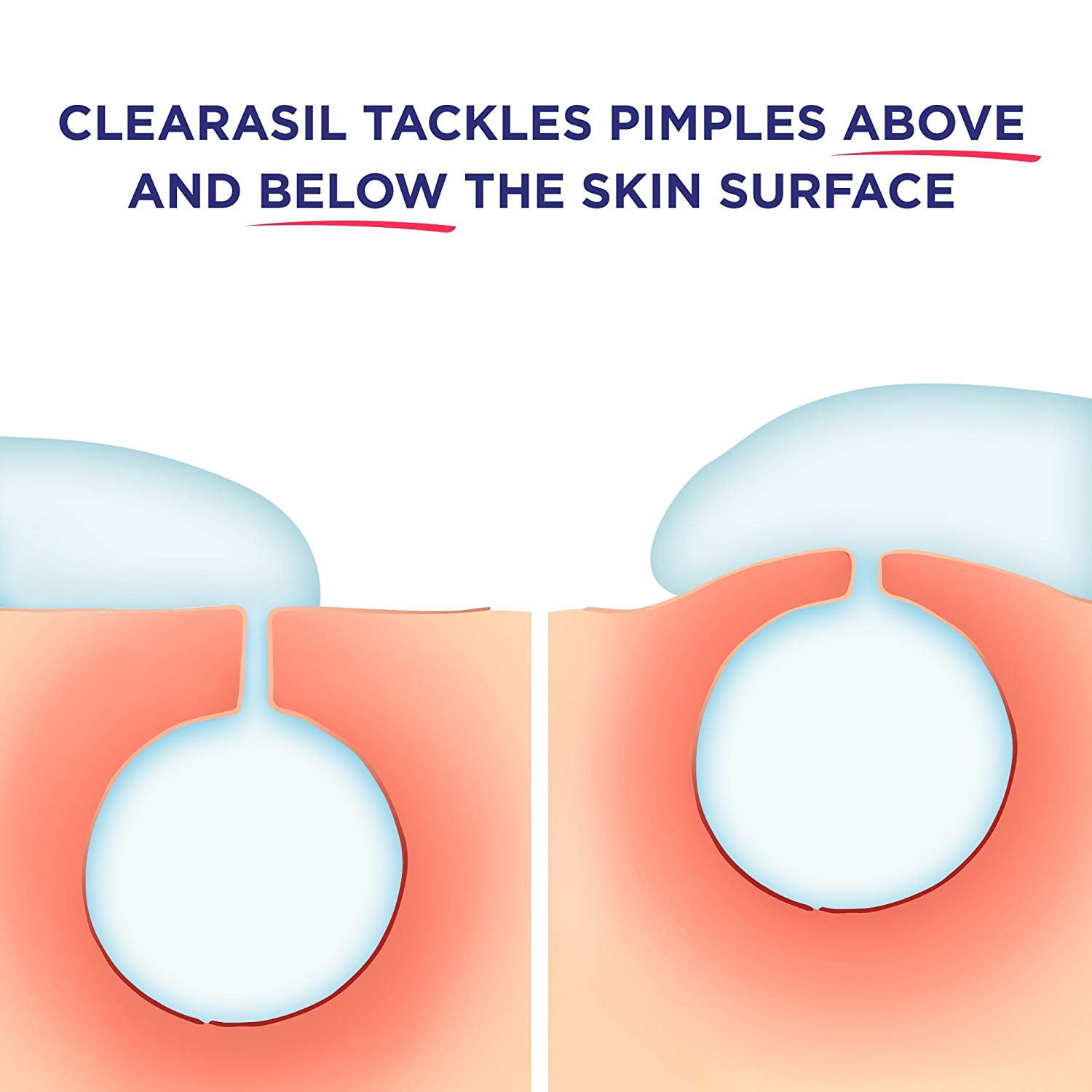 Rapid Rescue Deep Treatment Face Wash, 6.78 oz, Pack of 3 (packaging may vary), Visibly Clearer Skin in as little as 12 hours By Clearasil