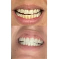 Smile Titan Teeth Whitening Gel Refill 4X Syringes 44 Carbamide