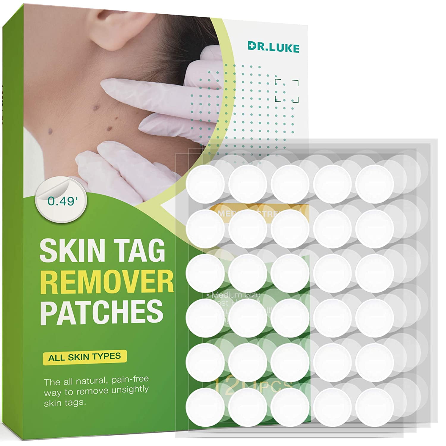 skin tag removal