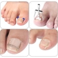 thumbnail image 4 of Juego de corrección de uñas encarnadas, Kit de tratamiento, corrector de uñas encarnadas de acero inoxidable, pinzas elevadoras, pegatina para uñas de los pies, 4 of 7