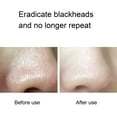 thumbnail image 4 of Device Blackheads Suction Device Facial Blackhead Vacuum Remover Pore Cleaner, 4 of 8
