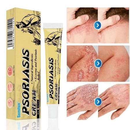 20g Dermatitis Cream Eczema Psoriasis Treatment for Itchy Skin Hives