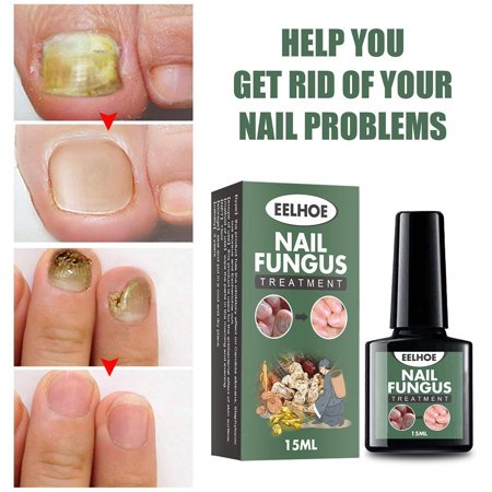 15ml Nail Fungal Liquid Anti Fungus Toenail Fingernail Nails Care Liquid