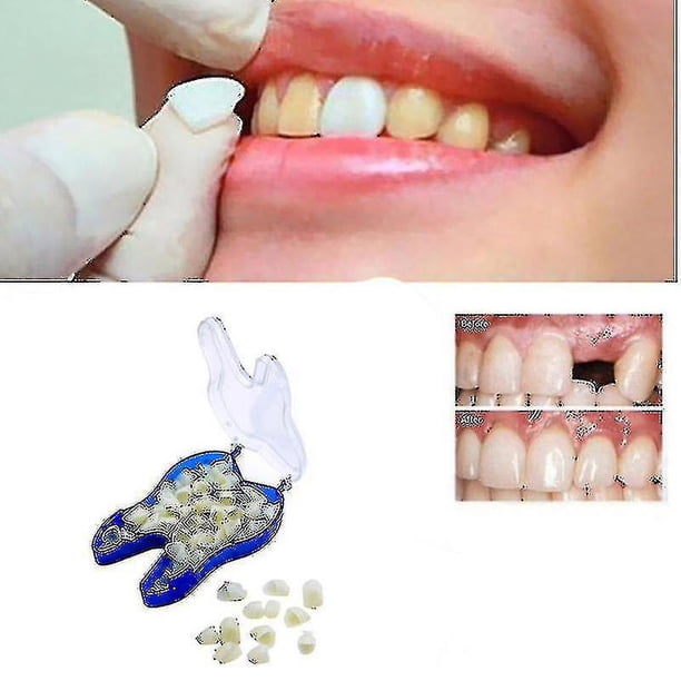 Aparatos de ortodoncia temporales LIUYMXG para dentaduras postizas aproximadamente 100 piezas