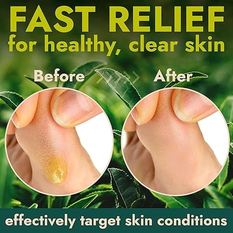 Tea Tree Callus Remover Gel | Professional-Grade Foot Exfoliant for Cracked Heels & Dry Feet | Instant Results & Soothing Hydration | Includes 3 Pumice Stones | 14 Fl Oz