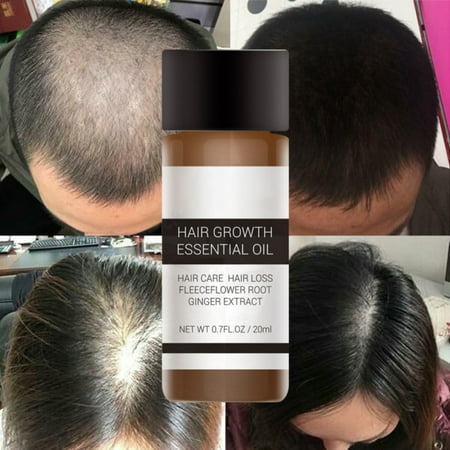 Fast Powerful Hair Growth Essence Products Essential Oil Liquid Treatment Preventing Hair Loss Hair Care (Best Hair Loss Products For Receding Hairline)