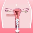 thumbnail image 2 of Jeringa femenina, ducha vaginal, botella vacía, cuidado personal, resistente a altas temperaturas para el período puerperal, 2 of 5