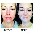 thumbnail image 3 of SkinSanity Clear Skin Results Regimen - All Natural Acne Treatment, 3 of 12