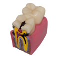 thumbnail image 1 of Caries Tooth Teaching Model: Decay Teeth Comparative Study Model Caries Bilateral Learning Teaching Tools for Patient Education, 1 of 3
