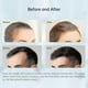 thumbnail image 3 of Bioneedle Derma Stamp 120 Titanium Microneedling Stamp Adjustable dermastamp 0-2, 3 of 5