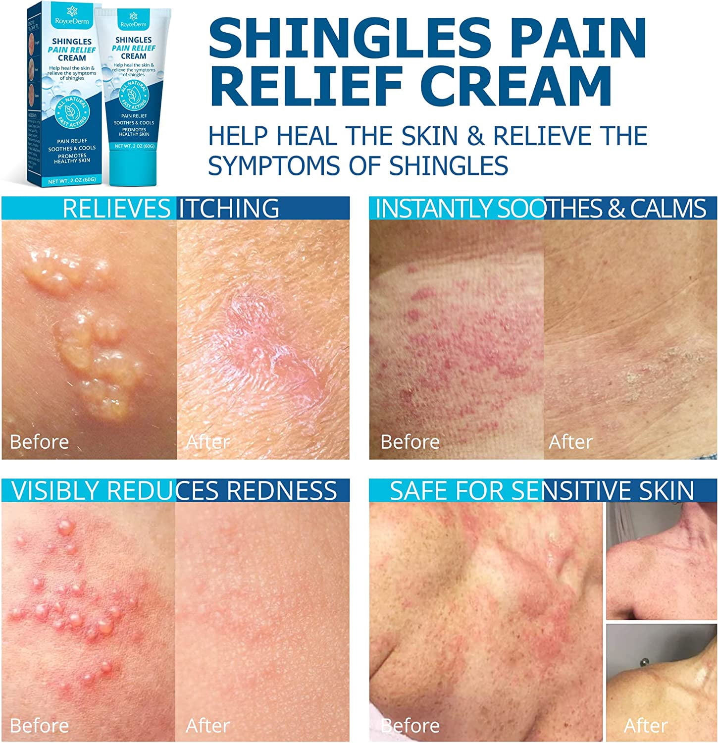 Shingles Treatment, Anti Itch Cream Extra Strength Shingles Pain Relief Cream, Itchy Relief Cream Shingles Skincare Cream for Eczema, Shingles, Hives, Nerve Pain, and Rashes