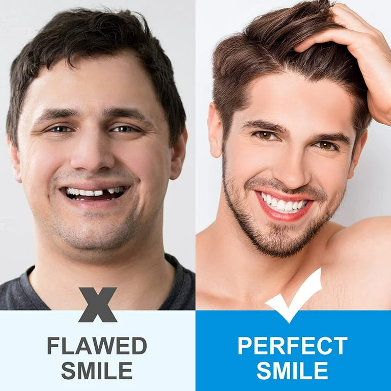SmileFix Basic Dental Repair Kit - Missing or broken tooth. Gaps