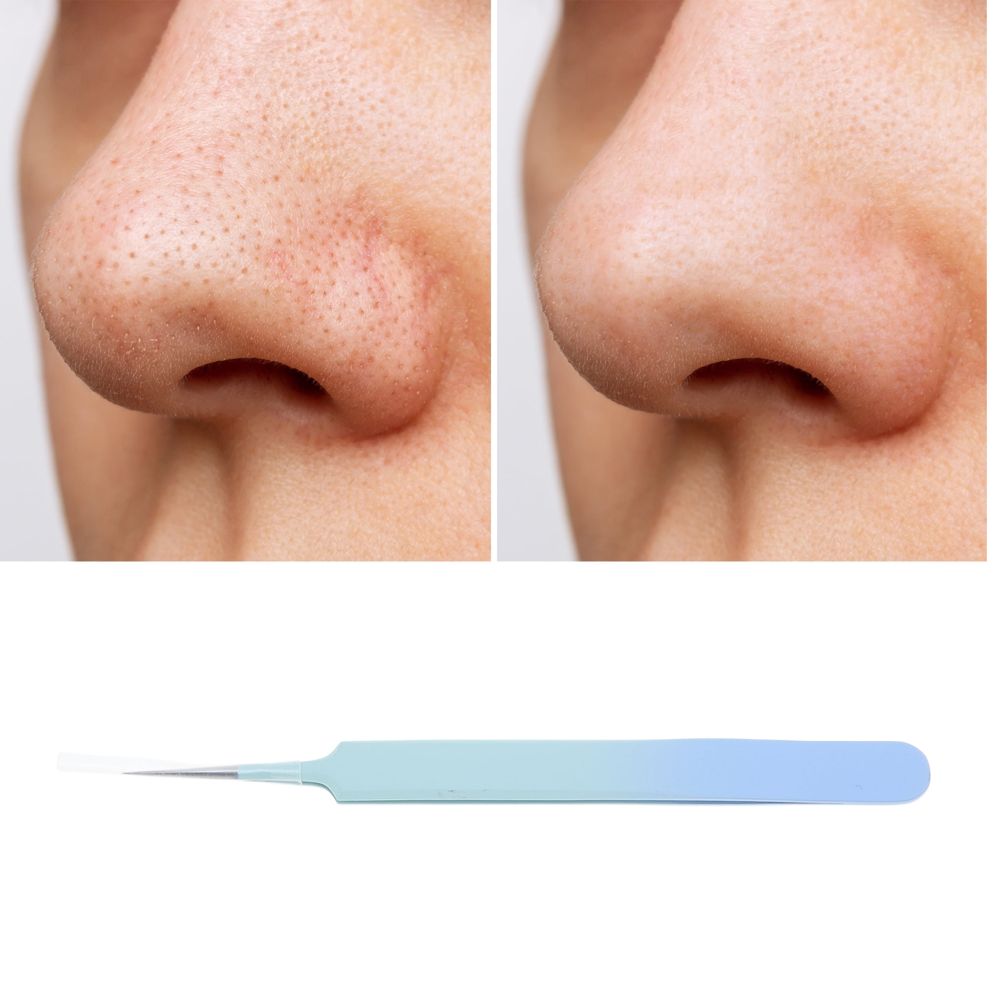 Unique Bargains 1pc Durable Squeeze Pimple Extractor Tool for Clear Skin Blue Green