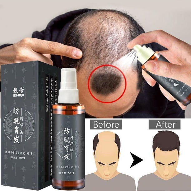Suero para el crecimiento rápido del cabello para hombres y mujeres, tónico para el crecimiento del cabello, suero anticaída para la caída del cabello, tratamiento para adelgazar el cabello, 2022