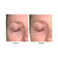 thumbnail image 4 of Tratamiento de levantamiento de párpados City Beauty | Crema de tratamiento de elevación de párpados con capucha | Tratamiento de estiramiento de ojos para párpados caídos, 4 of 9