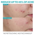 thumbnail image 2 of Sérum para el tratamiento del acné La Roche-Posay con ácido salicílico effaclar, 2 of 7