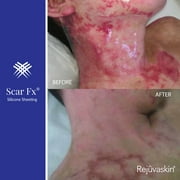 Rejuvaskin Scar Fx Silicone Sheeting - 3 x 5 - 100% Healthcare Grade Silicone - Physician Recommended