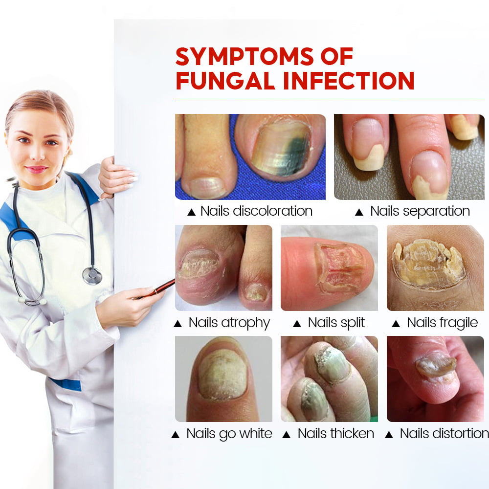 Fungal Nail Infection Treatments, Cotgrave, Rushcliffe, Nottinghamshire |  Belvoir Foot Health Clinic