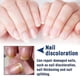 thumbnail image 3 of Formula Fungal Nail Paronychia Treatment Gel, Toenail Fungus Treatment, Extra Strength Nail Repair Solution For Finge, 3 of 5