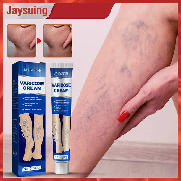 Crema de venas varicosas Crema de alivio de venas varicosas a base de hierbas 20g para piernas Venas de araña
