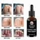 thumbnail image 2 of Anti-Fungal Nail Treatment Serum for Toes & Feet Care Essentials Repair Herb Solution Against Onychomycosis Paronychia Infections, 2 of 5