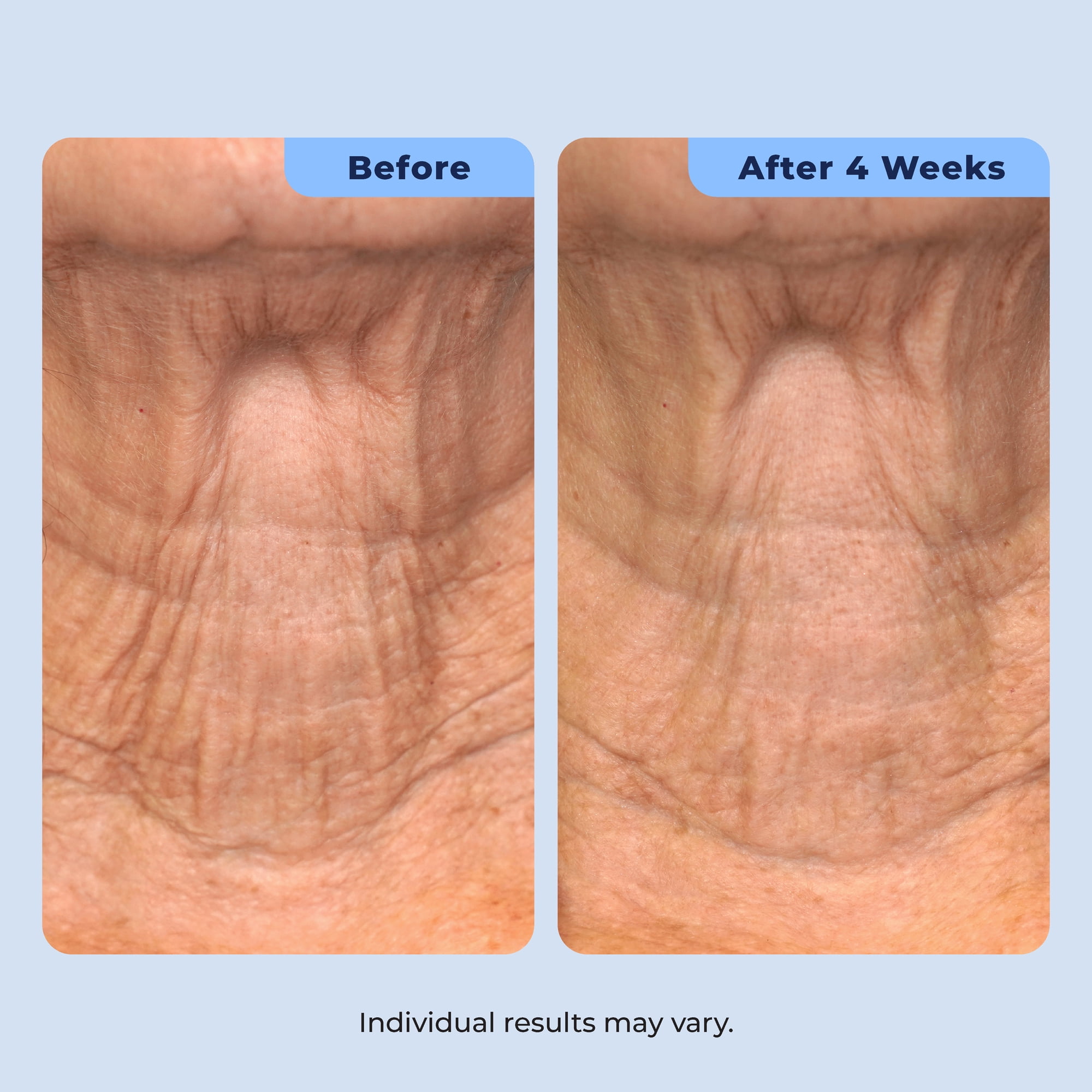 Plexaderm Dual Action Repair Cream for Neck, Chest & Arms – Firming Cream with Retinol & Bakuchiol for Crepey Skin, Fine Lines & Wrinkles