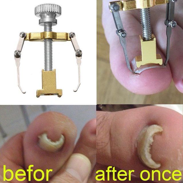 Fijador de uñas encarnadas de metal, herramienta portátil de recuperación de uñas, duradero para suministros para pies