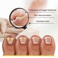 thumbnail image 5 of Toenail Repair Liquid Nail Fungus Hand And Foot Nail Bump, 5 of 5