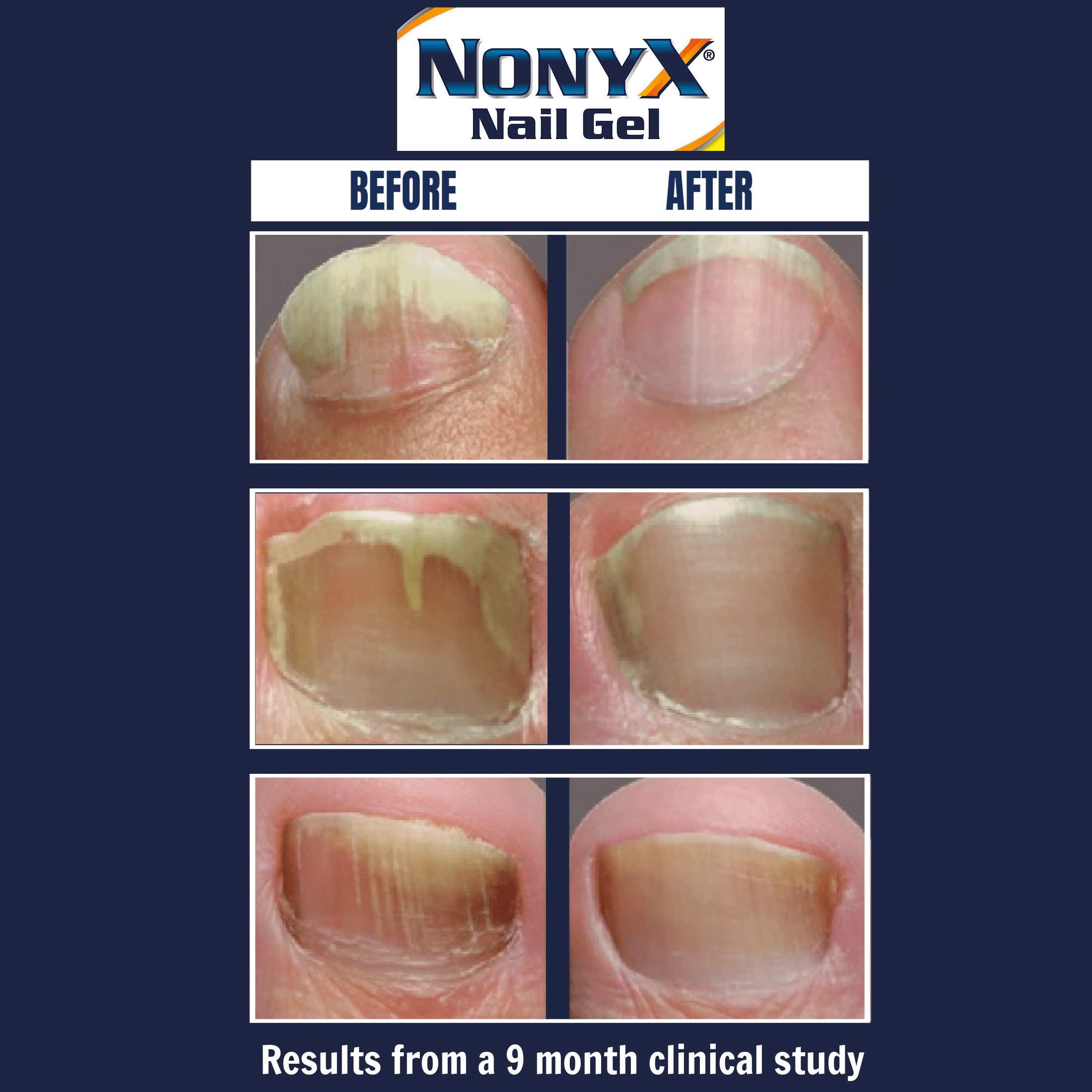 Nonyx Nail Gel Before And After