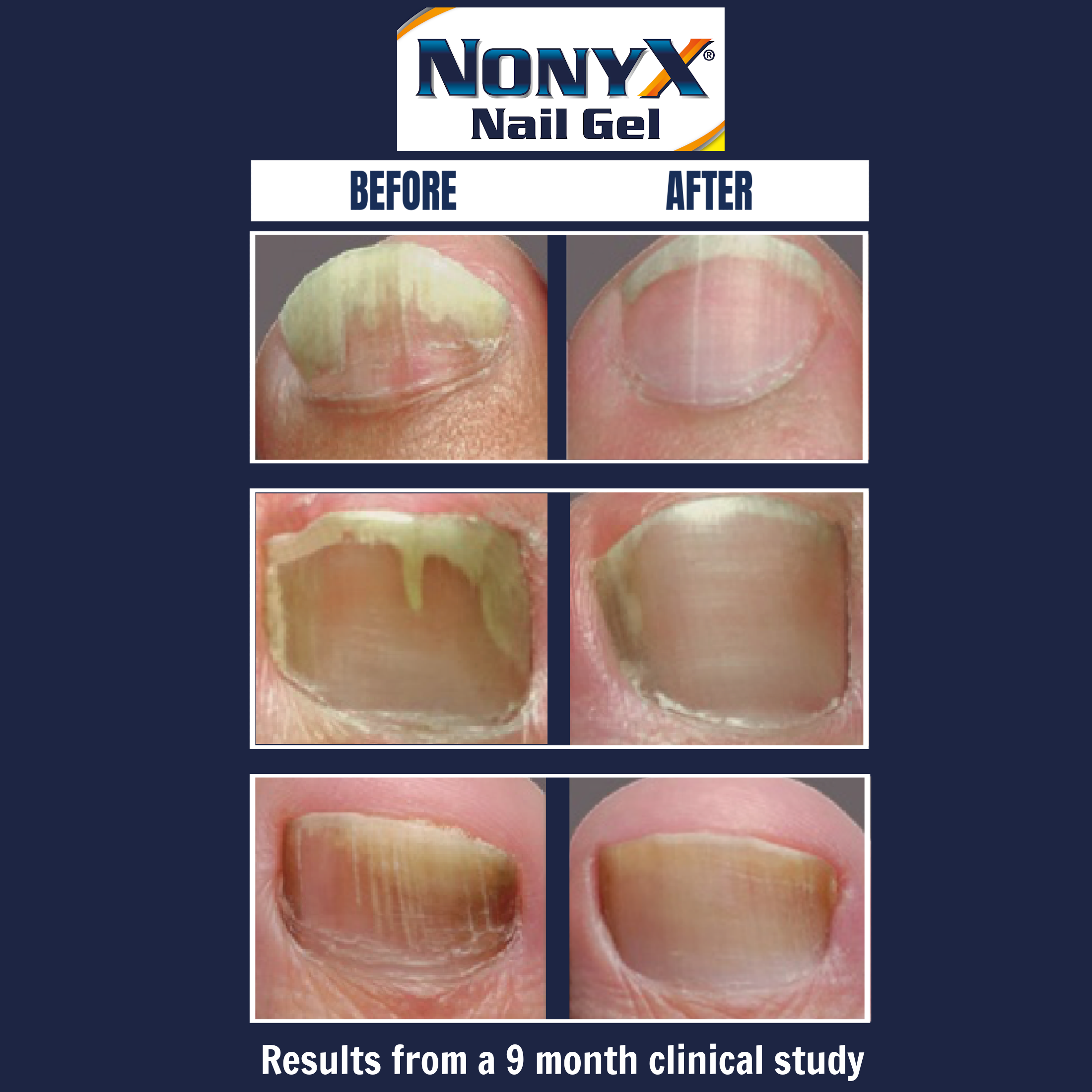 Nonyx Fungal Nail Clarifying Gel | Clinically Proven Effective for Fungus Damaged Toenails | Results are Money-back Guaranteed, 4 oz. - image 3 of 9