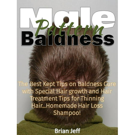 Male Pattern Baldness: The Best Kept Tips on Baldness Cure with Special Hair growth and Hair Treatment Tips for Thinning Hair...Homemade Hair Loss Shampoo! - (Best Solution For Baldness)