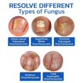thumbnail image 3 of Nail Fungus Cleaning Laser Device, Blue Light Nail Therapy For Damaged Discolored Thick Toenails & Fingernails, Effective Rechargeable Nail Fungus Rem, 3 of 4