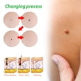 thumbnail image 3 of Líquido para eliminar verrugas Líquido para eliminar verrugas, eliminación de etiquetas de piel de acción rápida y efectiva, eliminación de verrugas Tratamiento de verrugas faciales y corporales Líqui, 3 of 3