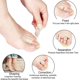 thumbnail image 5 of 4 Pieces Hammer Toe Hammer Toe Support Toe Splint For Toes, Hammer Toes, Claw Toes (one Toe) Banmo, 5 of 5