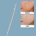 thumbnail image 4 of Professional Stainless Steel Blackhead Remover Tool, Dual-Ended Pimple Popper Kit for Acne, Whitehead, Blemish Extraction - Gentle & Precise Skincare Tool for Face, 4 of 7