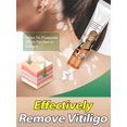 thumbnail image 2 of Ungüento para eliminar eficazmente el Vitiligo, pomada para eliminar manchas blancas, cuidado de la piel, 2 of 5