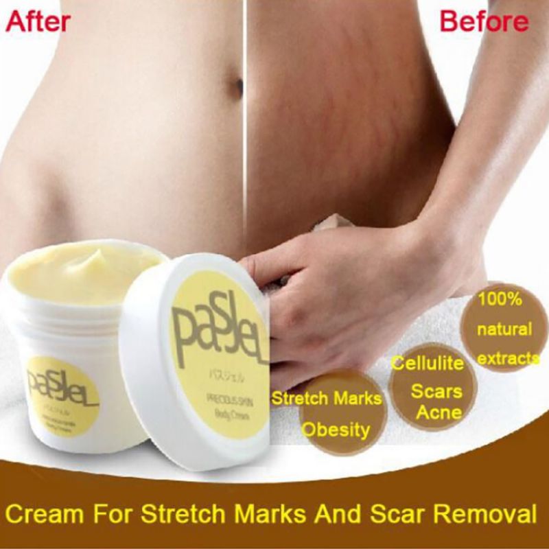 no 1 stretch mark removal cream