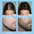 thumbnail image 4 of Micro- Roller 540 Hair Regrowth Beard Growth Hair Loss Skin Care Tool. 0.5mm, 4 of 9