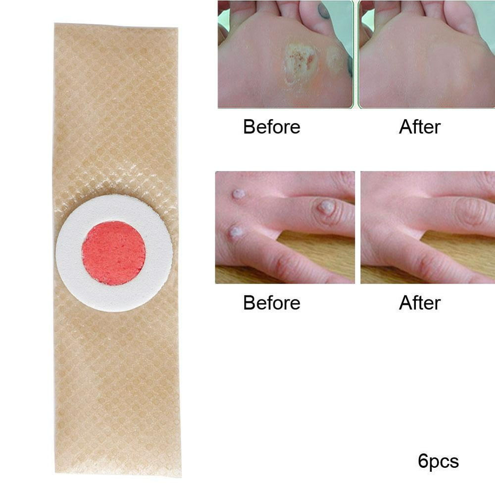 Tebru 6Pcs/Bag Foot Corn Removal Plaster Warts Thorn Patch Feet Callus