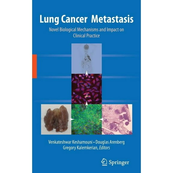 Lung Cancer Metastasis: Novel Biological Mechanisms and Impact on Clinical Practice, (Hardcover)