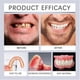 thumbnail image 3 of Advanced Customized Full Denture Set, Silicone Reline Denture Set, 3 of 5