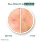 thumbnail image 2 of Parche hidrocoloide para espinillas Y'OUR Parches para acné, 56 unidades, 2 of 5