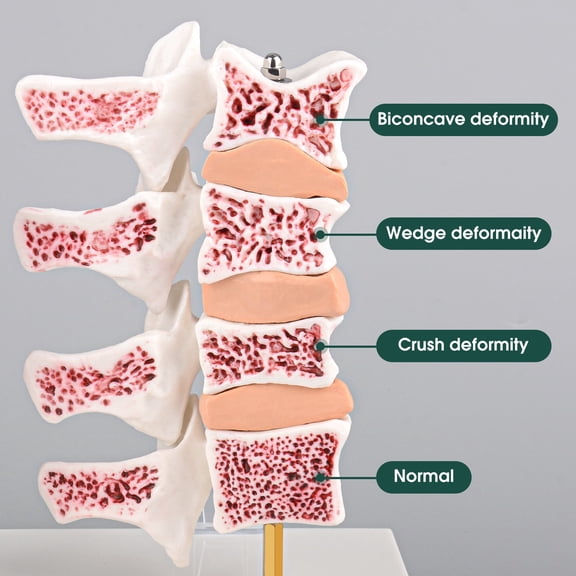 Eztrain Osteoporosis Model, Human Vertebrae Anatomical Model for Teaching Demonstration