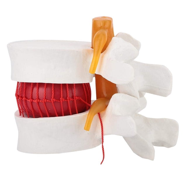 Yoidesu Modèle de Colonne Vertébrale Humaine, Modèle de Démonstration de herniation Lombaire Dégénérative (1:1.5)
