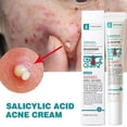 thumbnail image 4 of Crema para el acné LIWEI con ácido salicílico Aceite de árbol de té cuidado suave, 4 of 14