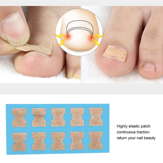 Sticker Corrector Inlay Nail Corrector Paronychia Care Recover Corrector Patch Correction ...