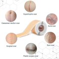 thumbnail image 3 of Silicone Scar Stickers Medical Silicone Easy-tear Gel Tape Roll Medical Grade, 3 of 5